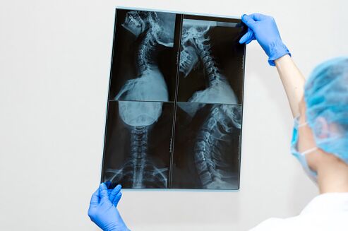 Osteochondroză Boala coloanei vertebrale