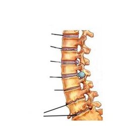 stadiile dezvoltării osteocondrozei