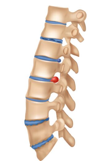 Cum arată osteochondroza dehing