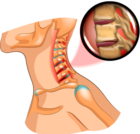 osteochondroză la gât