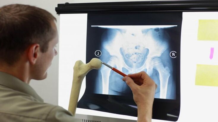 Doctorul examinează o radiografie pentru artroza șoldului